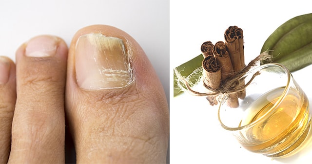 Here’s How to Treat Toenail Fungus and 4 Other Common Health Problems with Cinnamon